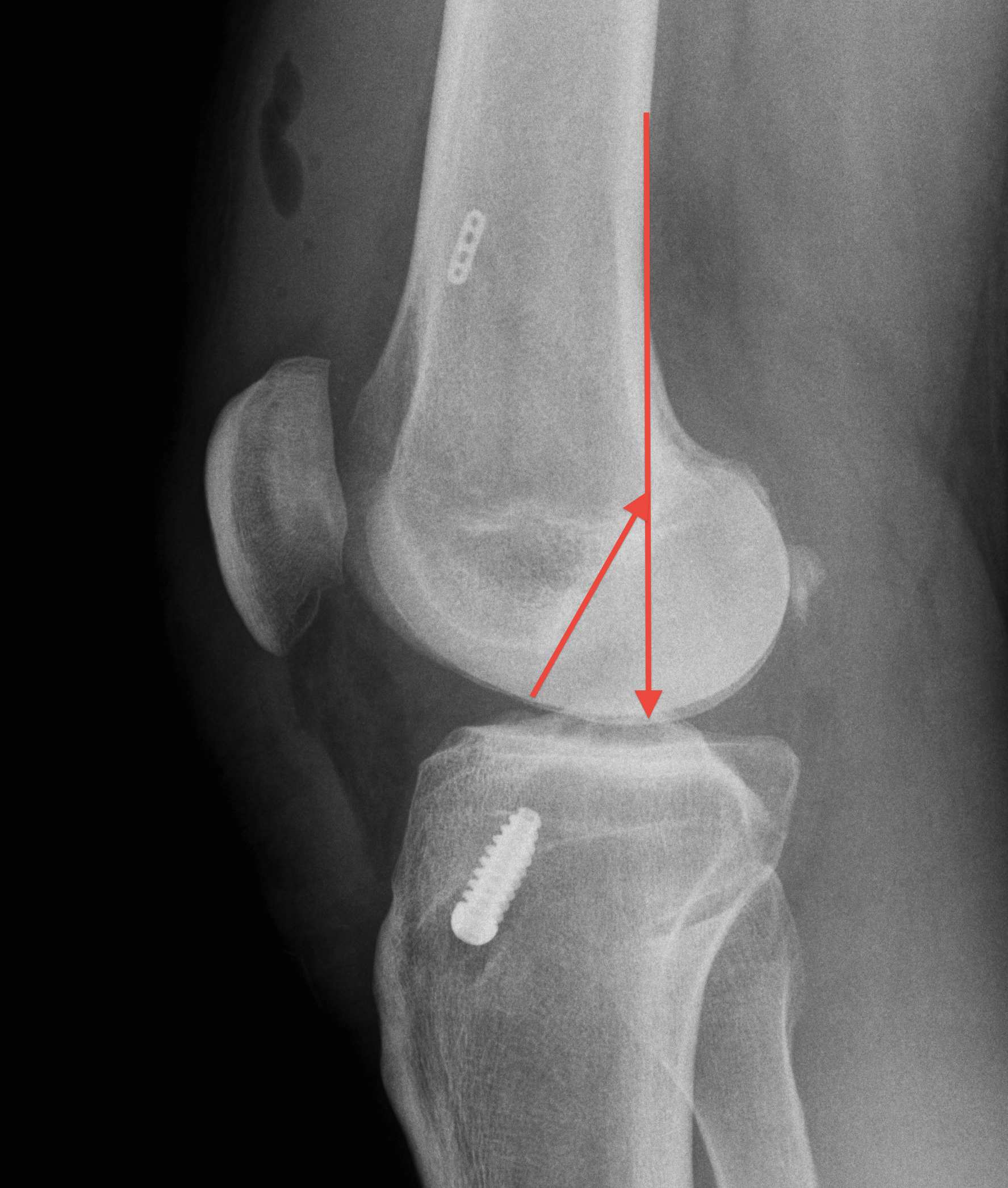 ACL Reconstruction Femoral Tunnels Sagittal